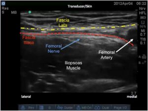 Femoral Nerve Block « VAULT